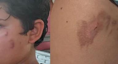 Akdeniz'de denize giren yanıklarla çıkıyor! Uzmanlardan uyarı geldi