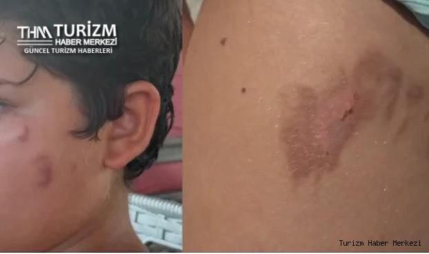 Akdeniz'de denize giren yanıklarla çıkıyor! Uzmanlardan uyarı geldi